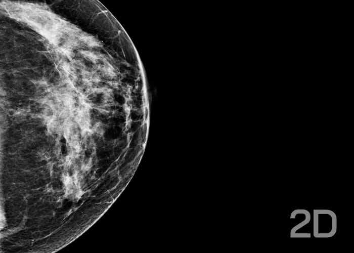 exemplu-mamografie-2d Exemplu mamografie 2d - Clinica Medicala Grama